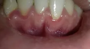 Смещение зубов