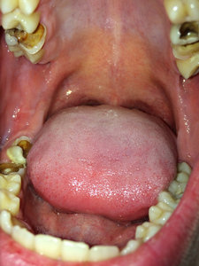 Травмы зубов: вывих зуба