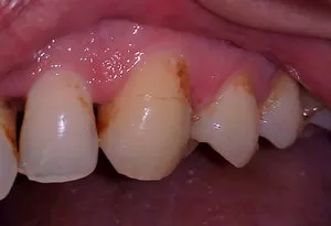 Трещина в эмали зуба