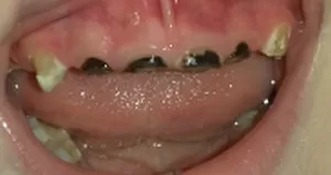 Гематома в полости рта: причины, симптоматика явления и способы лечения