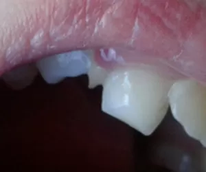 Сломался зуб - что делать? Методы восстановления и реставрации