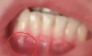 Шишка на десне, что это такое, причины и лечение – статьи стоматологической клиники «Доктор Мартин»