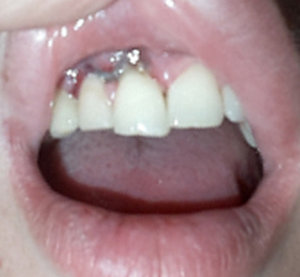 Травмы зуба: виды повреждений и лечение — ROOTT