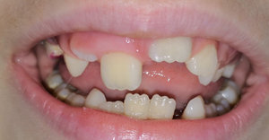 Почему молочные зубы у детей могут прорезаться не по порядку