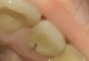 Пятна на зубах