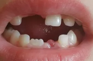 Сон про выпадение зубов