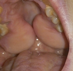 Что делать, если десна отошла от зуба?
