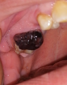 Губка в лунке после удаления зуба фото