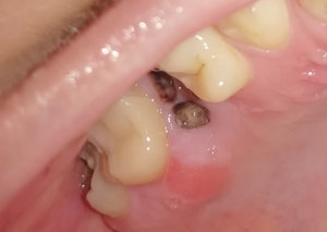 Осложнения при зубной имплантации