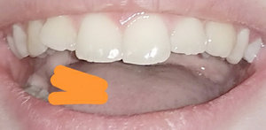 Недавно потерял передний зуб - насколько это критично в плане привлекательности?
