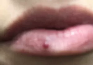 Прозрачная шишка на внутренней стороны губы, что это?