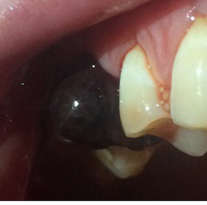 Альвеолит лунки зуба: как выглядит и что из себя представляет
