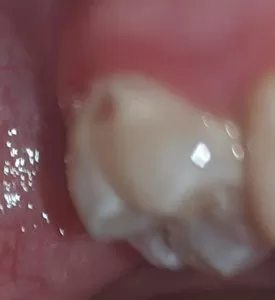 Почему появляется дырка в зубе и что с ней делать?