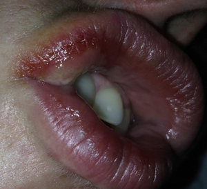 Кровяной шарик внутри губы