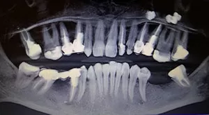 Обтурация корневых каналов зубов