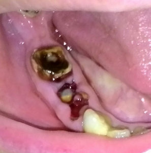 От зуба остался только корень: восстановление без имплантации