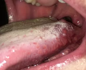 Воспаления слизистой рта и стоматит