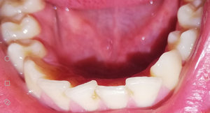 Почему болят молочные зубы?