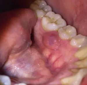 Болит укол после лечения зуба
