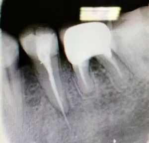 Под корень зуба попал пломбировочный материал