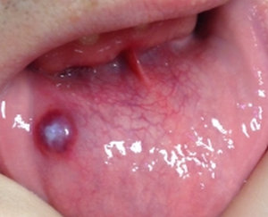 Герпес на губе | Причины, Симптомы, Лечение и Профилактика | DentalOpera