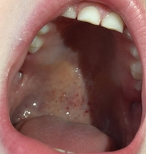 Боль у основания языка после появления красных пятен во рту на нёбе