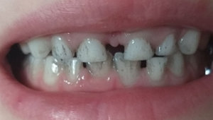 Появление полосок на поверхности зубов