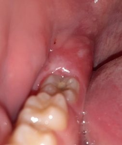 Почему опухла десна у зуба: стоматологические причины