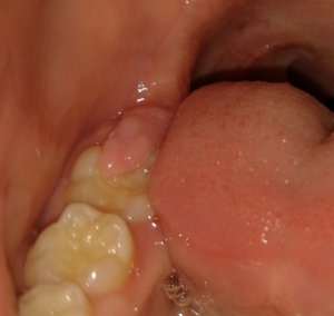 Основные причины, по которым происходит опухание десны вокруг зубов
