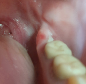 Лечение экзостоза после удаления зуба недорого в стоматологии Кредо в Реутове и Новокосино
