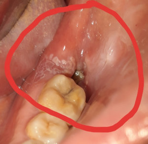 Восстановительный период после удаления зуба