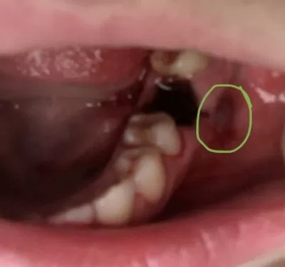 Причины появления боли в челюсти после удаления зуба