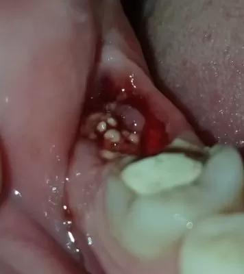 Как вырвать зуб без боли