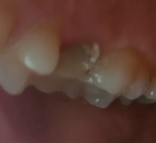 Остался осколок после удаления зуба