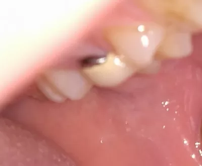 Десна отошла от зуба