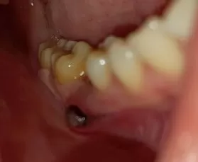 Швы после имплантации зубов