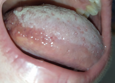 Почему появляются язвы во рту и как их лечить