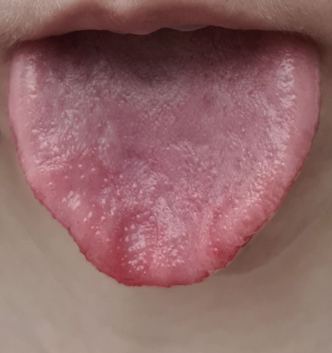 Симптомы появления язвы и вавок во рту