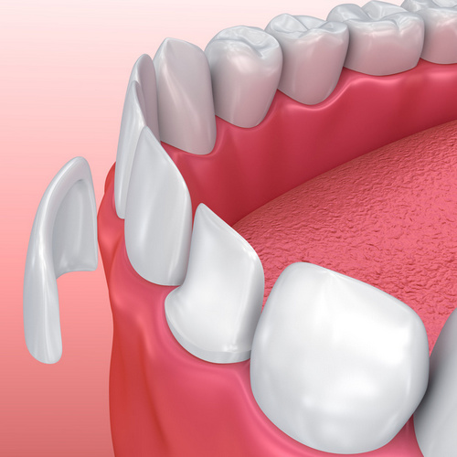 Керамические виниры под ключ
