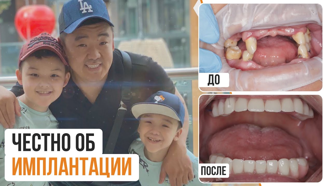 Имплантация зубов до/после😍. Чудесное преображение пациента! Реальный отзыв.