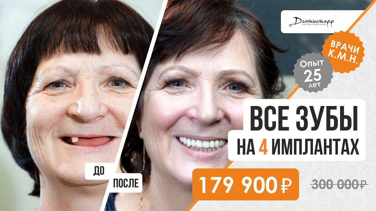 Полное протезирование всех зубов 😎 на 4 имплантах за 179 900 ₽. Несъемный протез.
