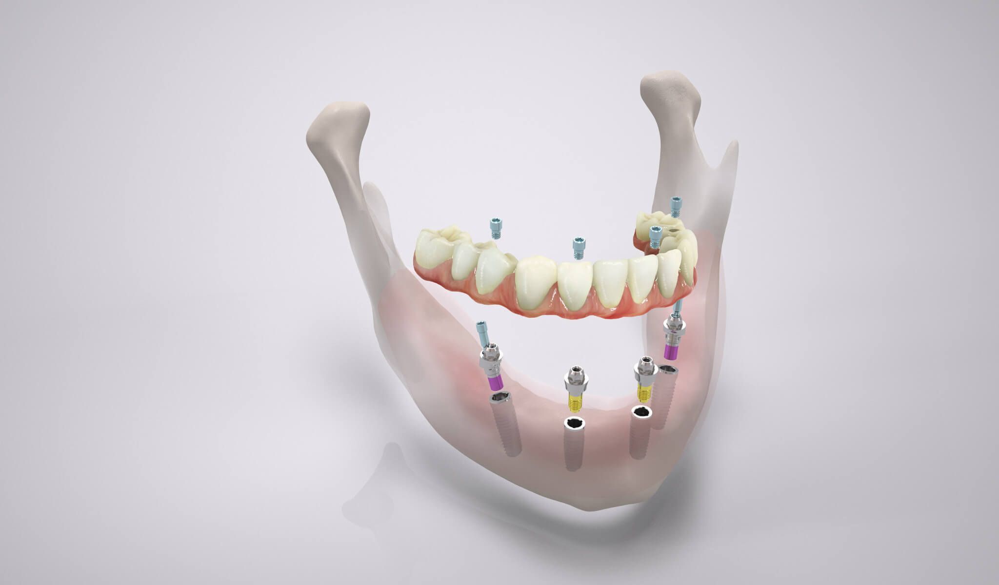 Импланты ол. Протезирование на 4 имплантах all-on-4.