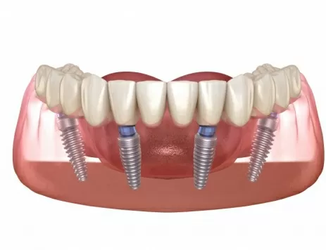 Протезирование всех зубов на 4 имплантах