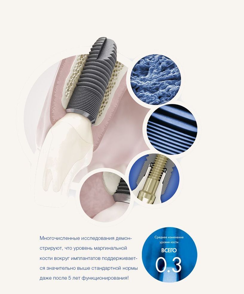 Имплантация Astra Tech с коронкой под ключ!