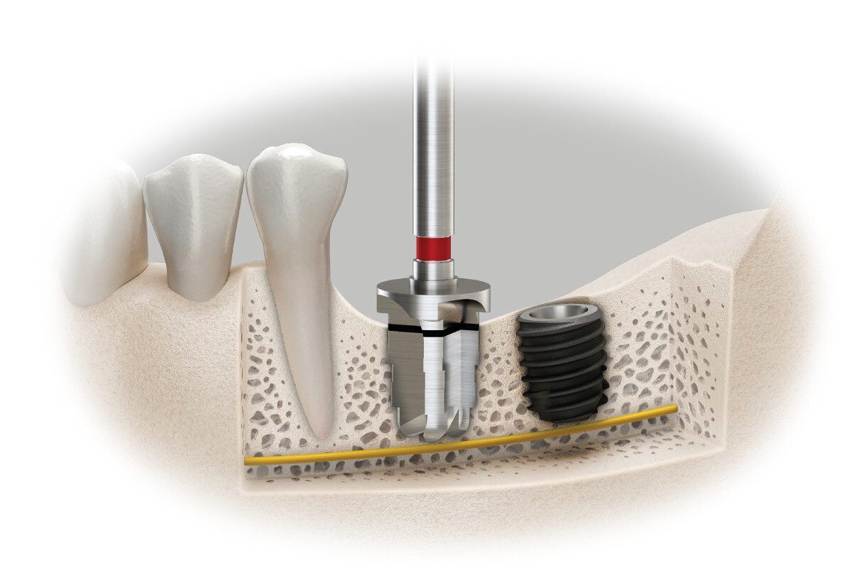Установка импланта под ключ OSSTEM