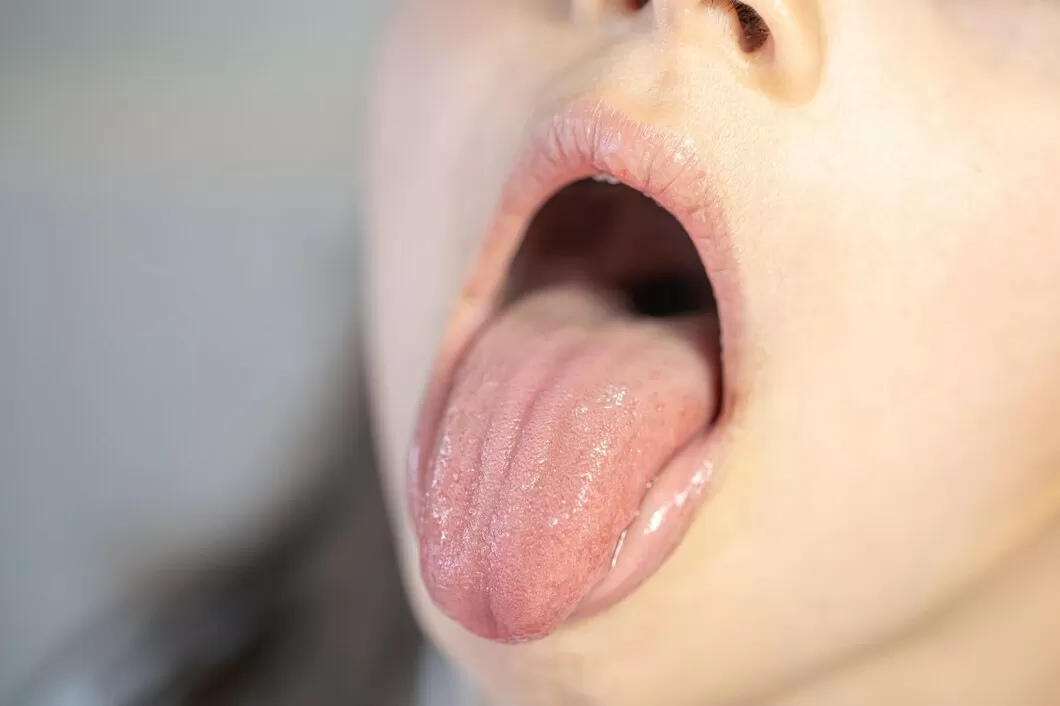 Глоссит на языке у детей