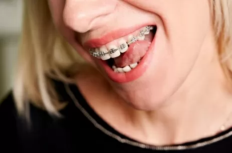 Брекеты Металлические под ключ всего за 145000Р!