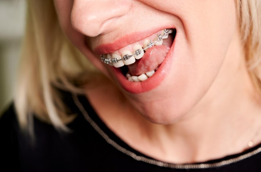 Брекеты Металлические под ключ всего за 145000Р!