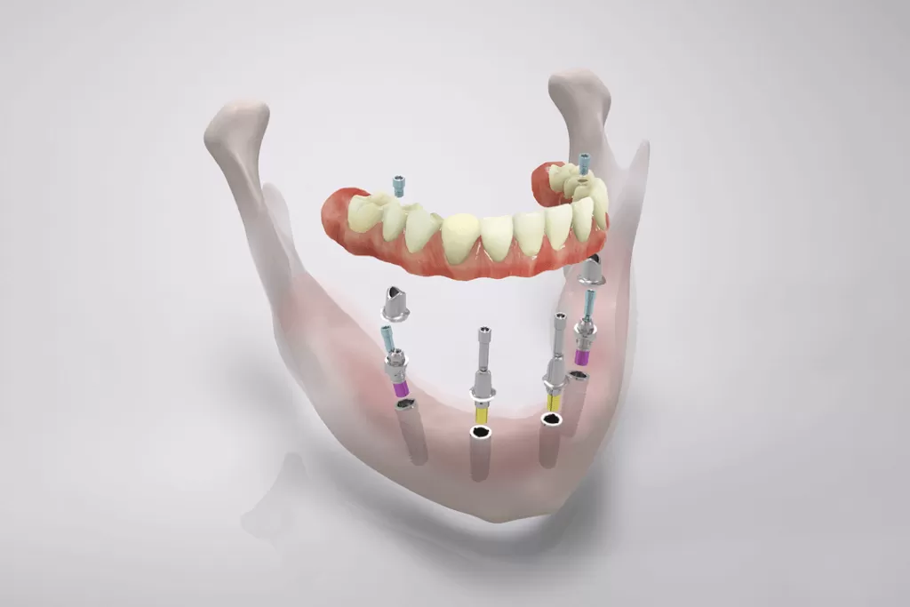 Имплантация по методу «Система четырёх опор»