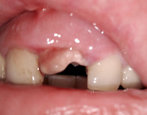 Белый сгусток после удаления зуба фото